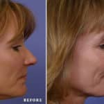 FACE-Nose_lk1