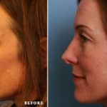 FACE-Nose_s1