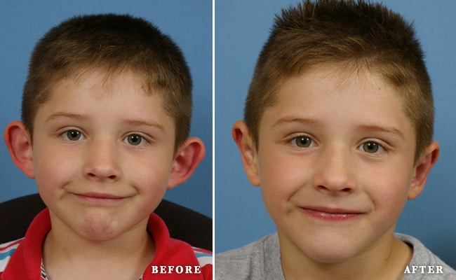 before_after_img