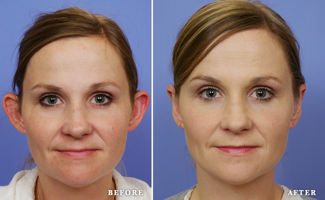 before_after_img