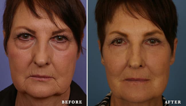 before_after_img