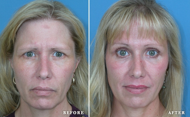 before_after_img