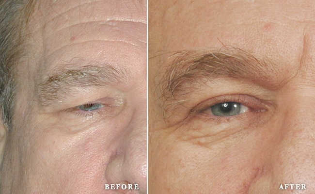 before_after_img
