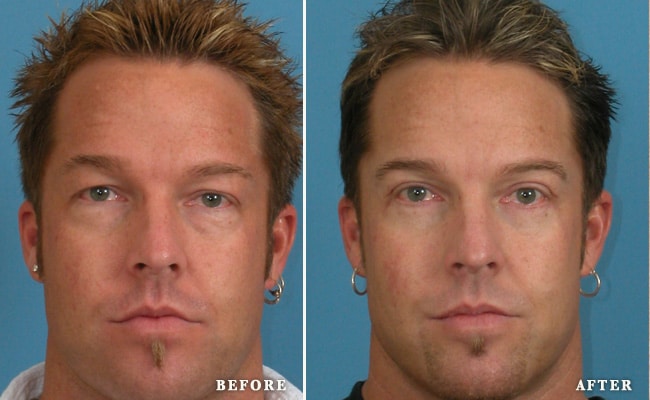 before_after_img