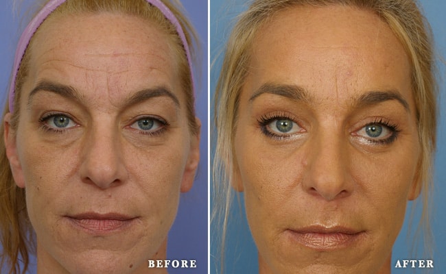 before_after_img