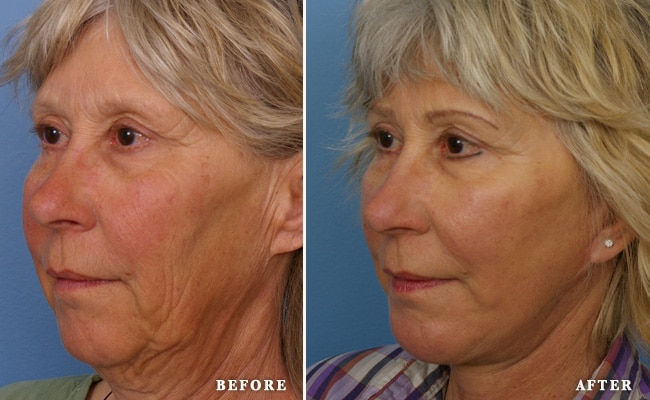 before_after_img