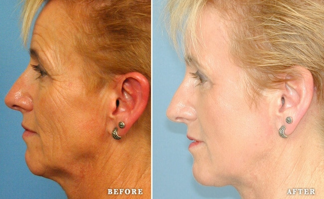 before_after_img