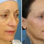 FACE-laserFix