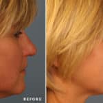 FACE-nose-16