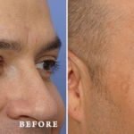 FacesFirst_Denver-Lone-Tree_Botox-4-AP