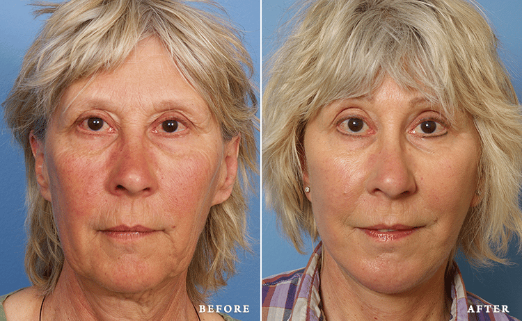 before_after_img