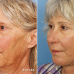 Picerno_Denver-Lone-Tree_Lower-Facelift-Necklift-1-LeftOBL