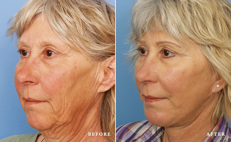 before_after_img