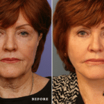 Picerno_Denver-Lone-Tree_Lower-Facelift-Necklift-4-AP