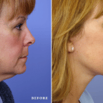 Picerno_Denver-Lone-Tree_Lower-Facelift-Necklift-5-RightLAT