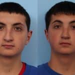 Rhinoplasty Denver Patient 31 (1)