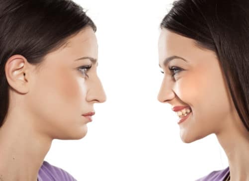 How a Revision Rhinoplasty can Improve Poor Results