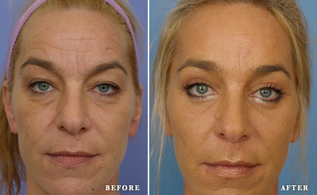 blepharoplasty 