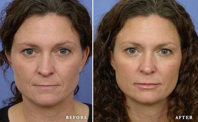 Botox®before and after