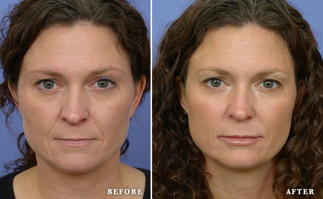 Botox®before and after
