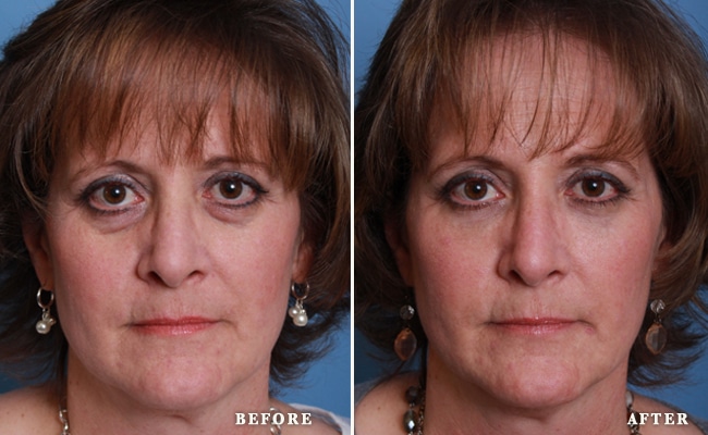 Restylane