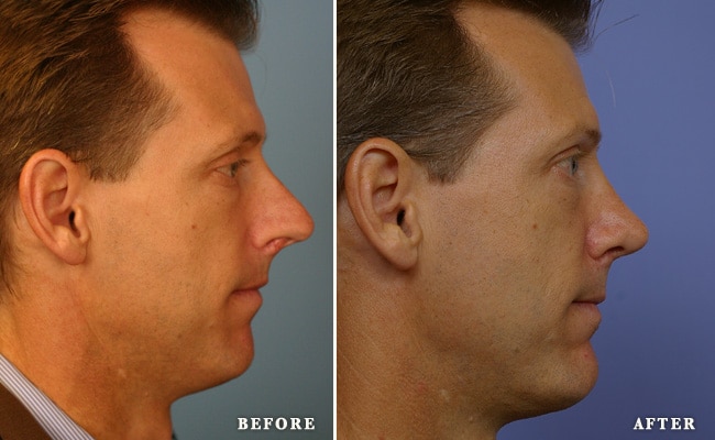 cheek & chin implants
