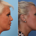 Picerno_Denver-Lone-Tree_Kybella-1-RightLAT