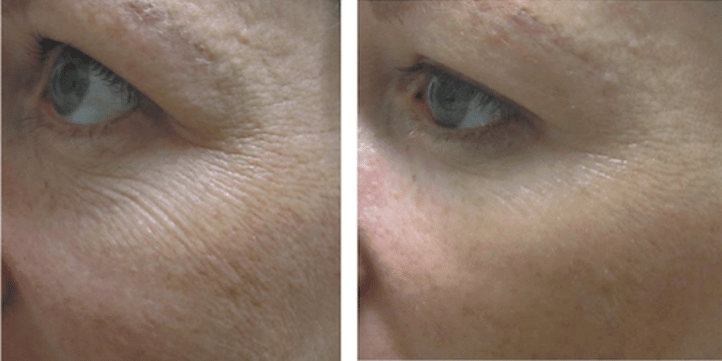 before_after_img