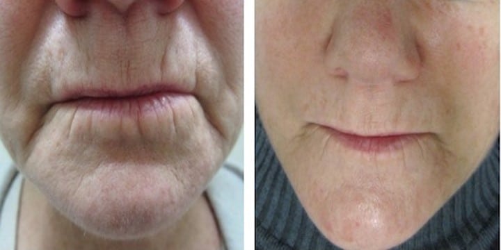 before_after_img