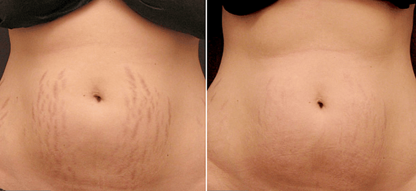 before_after_img
