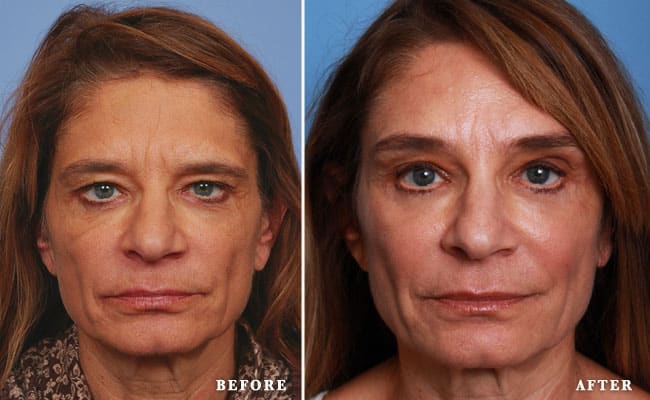 Forehead lift