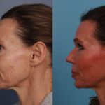 2 Mixto CO2 Laser (1)
