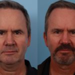 Lower Facelift Necklift 3 (2)