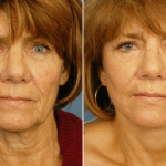 Picerno_Denver-Lone-Tree_Lower-Facelift-Necklift-2-AP