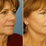 Picerno_Denver-Lone-Tree_Lower-Facelift-Necklift-2-RightOBL