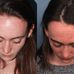 Rhinoplasty-2