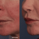 FacesFirst_Denver-Lone-Tree_Liplift-1-Left