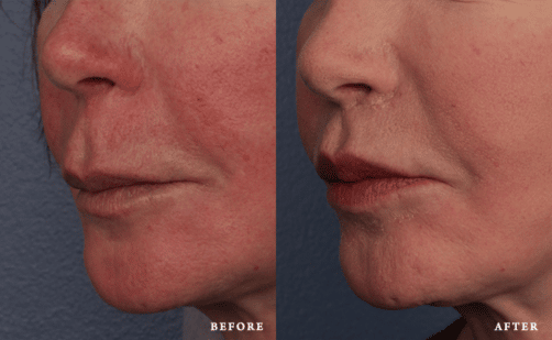 lip lift