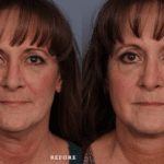 FacesFirst_Denver-Lone-Tree_Renuvion-Plasma-Lift-1-AP