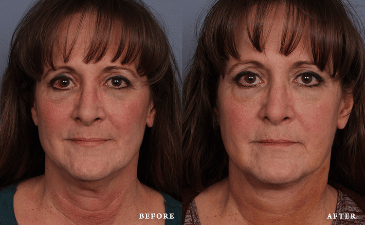 before_after_img