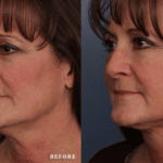 FacesFirst_Denver-Lone-Tree_Renuvion-Plasma-Lift-1-LefOBL