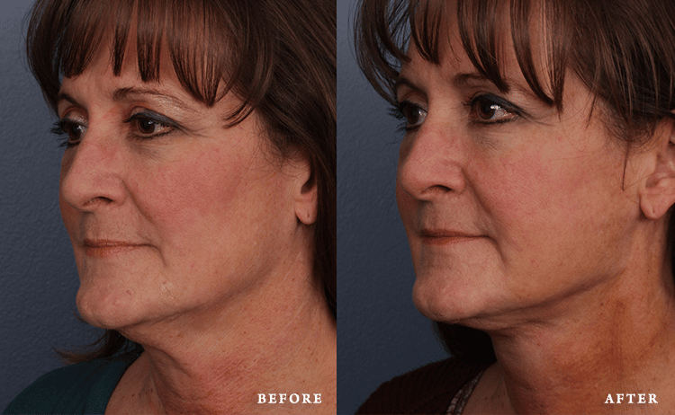 before_after_img