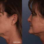 FacesFirst_Denver-Lone-Tree_Renuvion-Plasma-Lift-1-Left