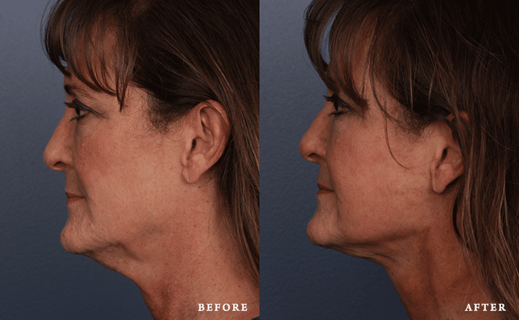 before_after_img