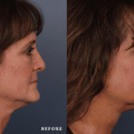 FacesFirst_Denver-Lone-Tree_Renuvion-Plasma-Lift-1-Right