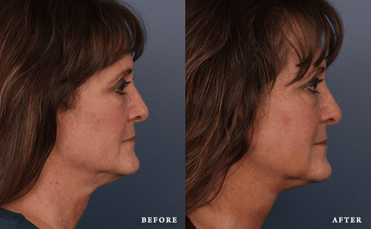 before_after_img
