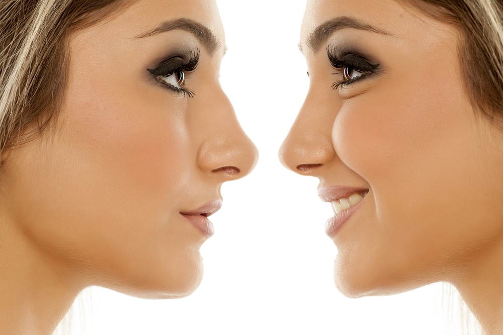 Preparing for Recovery from Rhinoplasty