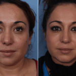 Cote_Denver-Lone-Tree_Revision-Rhinoplasty-1-AP