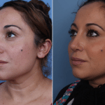 Cote_Denver-Lone-Tree_Revision-Rhinoplasty-1-LeftOBL
