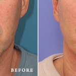 Picerno_Denver-Lone-Tree_Chin-Augmentation-3-AP